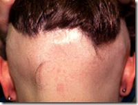 Alopecia Areata