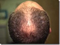 Androgenic-alopecia