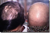 Trichotillomania