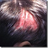 hair loss tinea