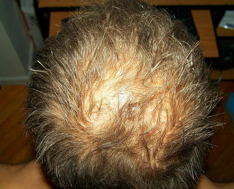 http://www.stopnowhairloss.com/wp-content/uploads/2008/02/male-baldness.jpg