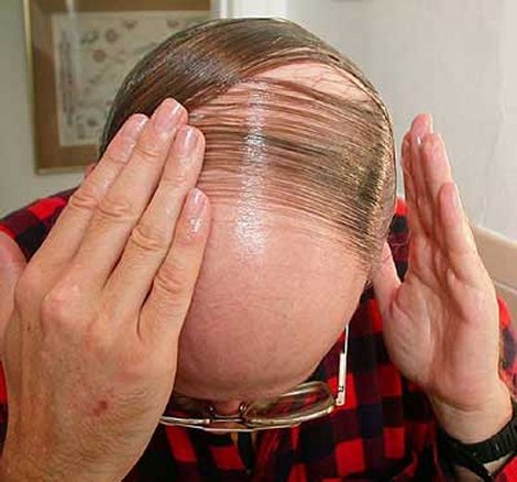 male-pattern-baldness_.jpg